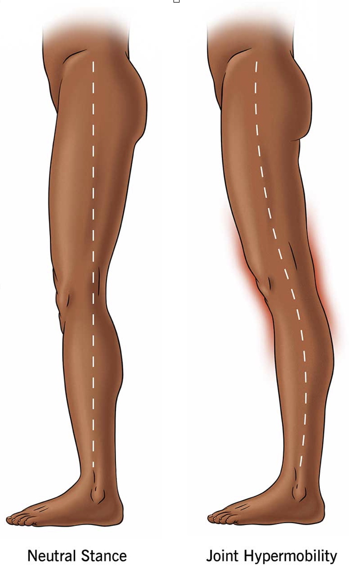 Hüpermobiilsus põlv