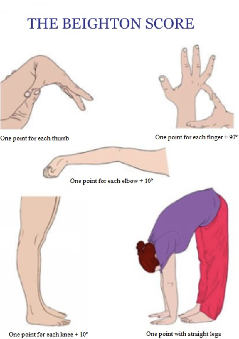 Hüpermobiilsuse hindamine